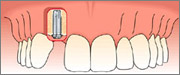 single tooth replacement