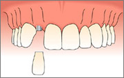 single tooth replacement