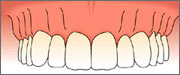 single tooth replacement